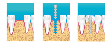 Implant dentaire Aubagne