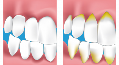 Soins des gencives dentiste Aubagne